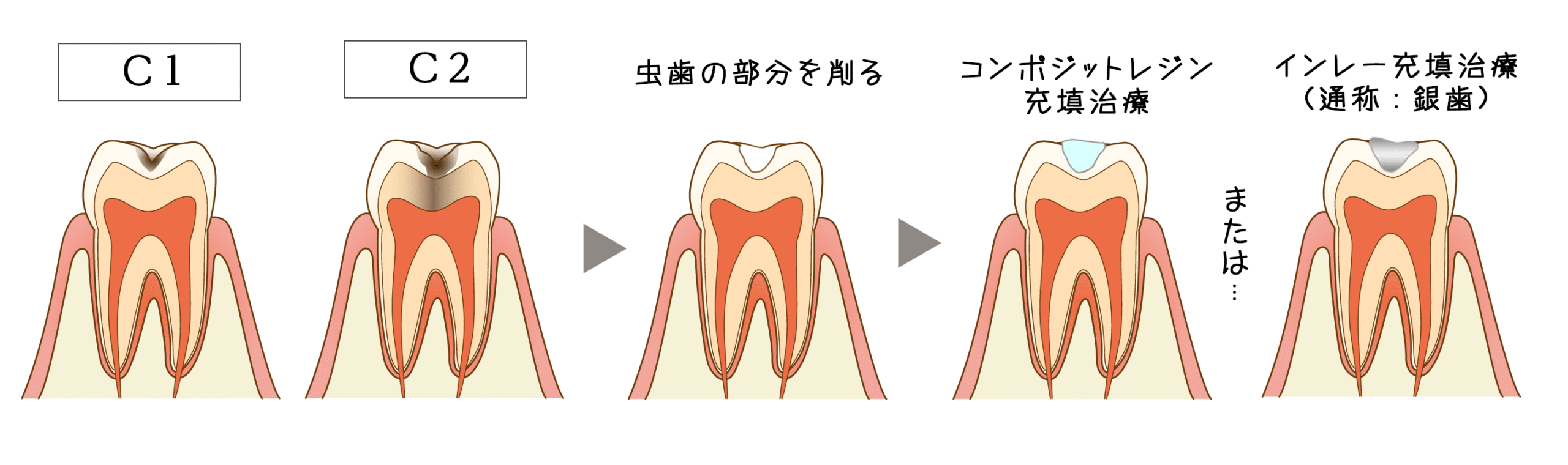 虫歯の治療・新前橋かわまがりファミリー歯科