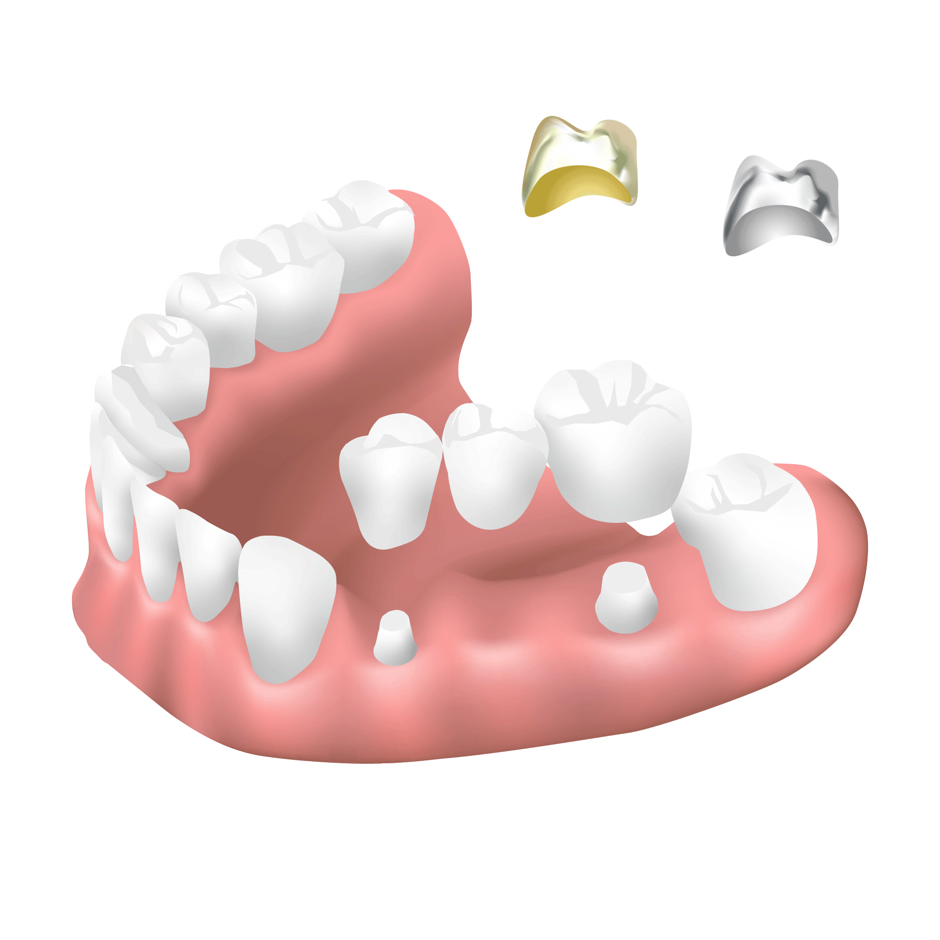補綴治療・新前橋かわまがりファミリー歯科
