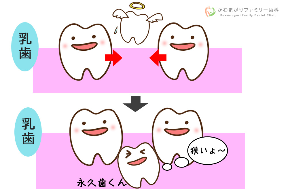 乳歯が虫歯になった時の永久歯への影響