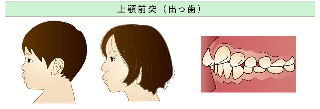 出っ歯・上顎前突・かわまがりファミリー歯科・前橋