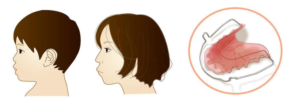 矯正歯科・かわまがりファミリー歯科・新前橋