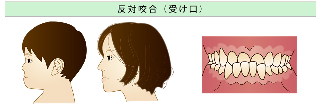 受け口（反対咬合）矯正歯科・かわまがりファミリー歯科