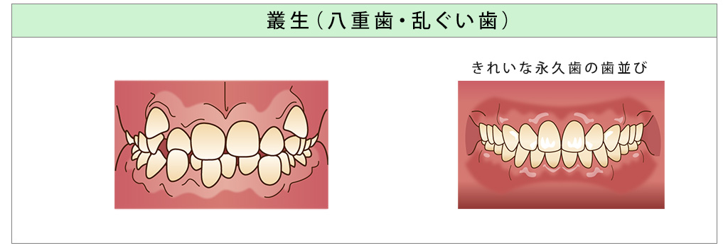 八重歯・乱ぐい歯（叢生）
