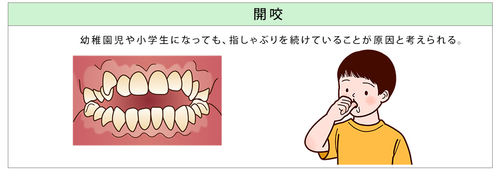 開咬・指しゃぶり・矯正歯科・かわまがりファミリー歯科